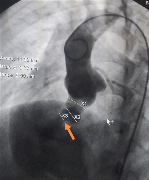 图3. 术中升主动脉造影示主动脉窦瘤破裂，箭头所指系破口处.jpg