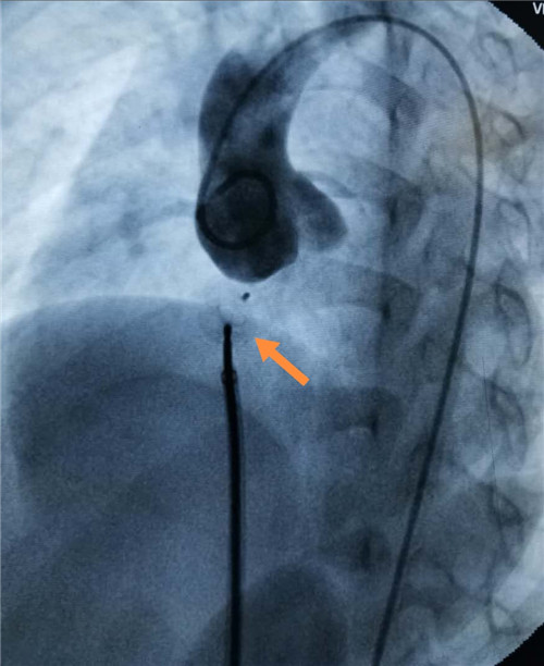 图4. 术后升主动脉造影示主动脉窦瘤破裂封堵成功，箭头所指系封堵器.jpg